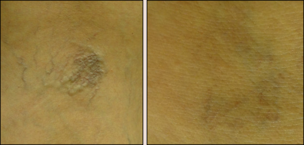 laser vein removal